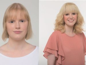 Haarverdichtung vorher nachher